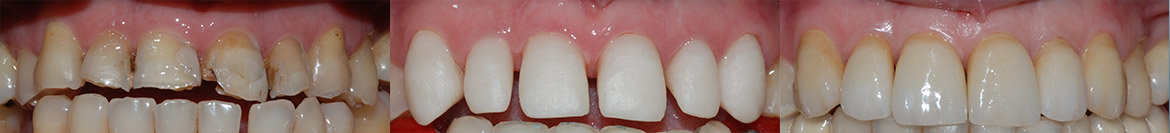 corone in zirconio, denti, protesi, disilicato, poliedro, centro dentistico, Piacenza.