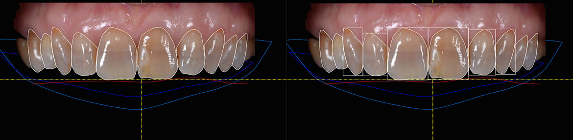 smile design, sorriso, poliedro, centro dentistico, Piacenza.