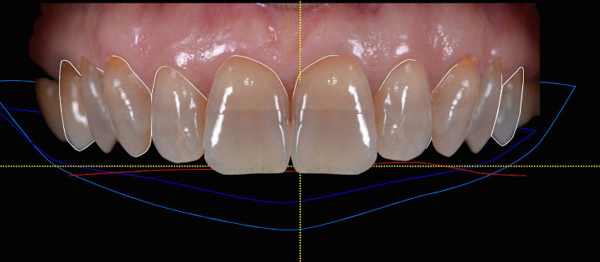 smile design, sorriso, poliedro, centro dentistico, Piacenza.