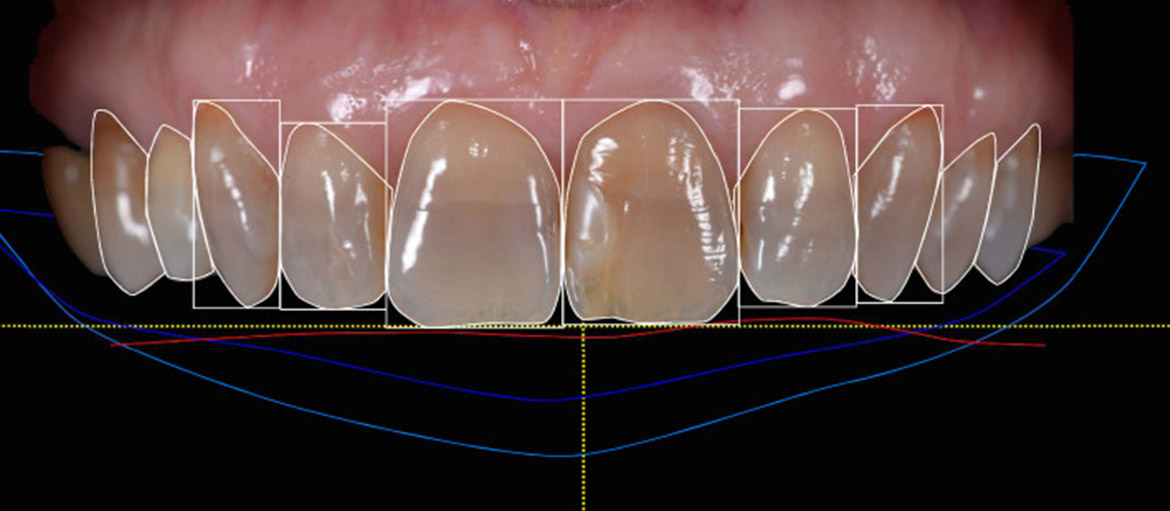 smile design, sorriso, poliedro, centro dentistico, Piacenza.