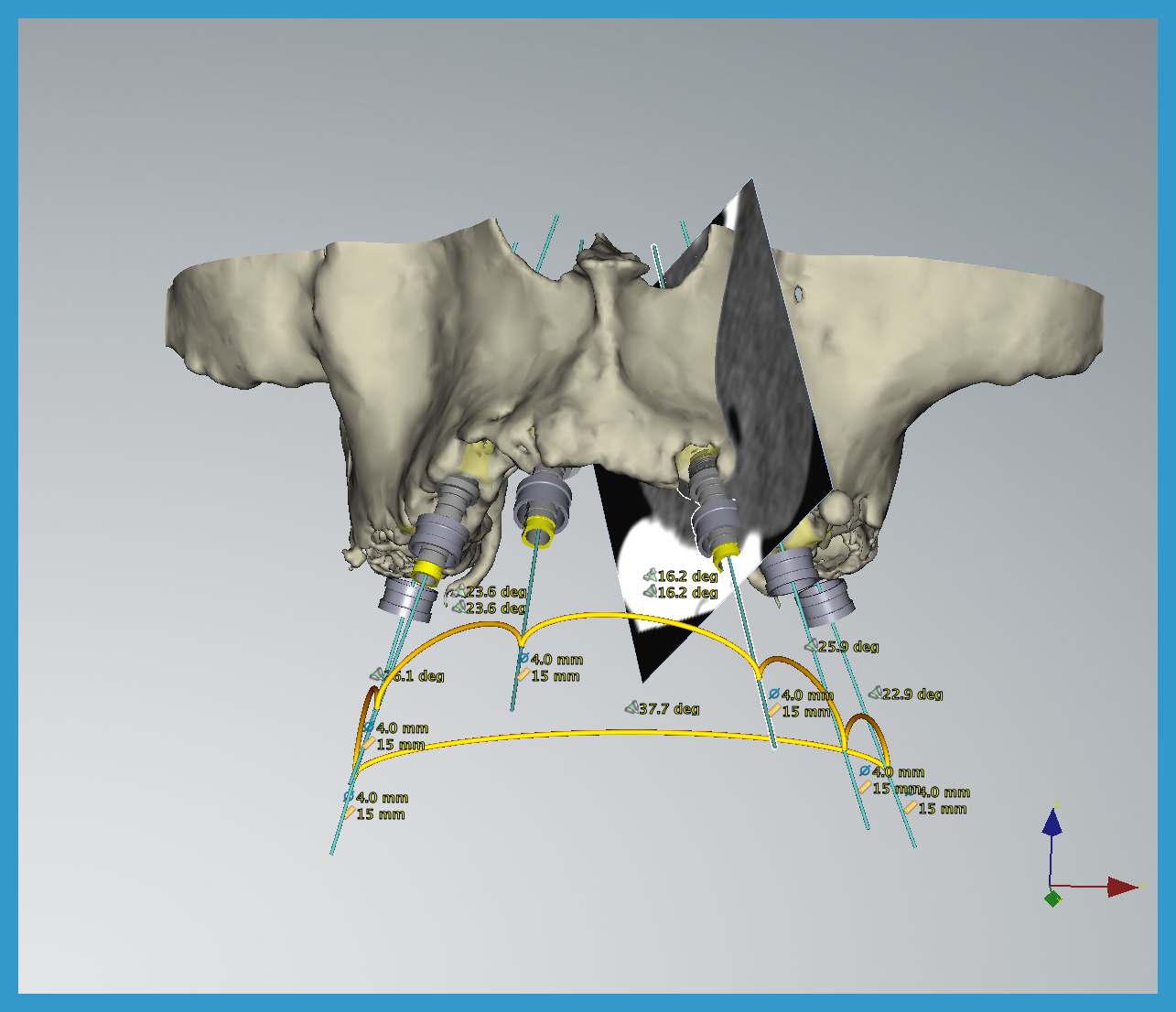 3 vengono individuati le posizioni ottimali per gli impianti e inseriti nel volume di osso evidenziato precedentemente nella TAC